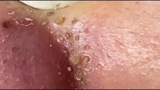 TOP OF BLACKHEADS REMOVAL FROM THE NOSE  #relaxing  #blackheads