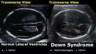 Fetal Ultrasound Normal Vs Down Syndrome | Soft Markers In Fetus For Trisomy 21 | Aneuploidies USG