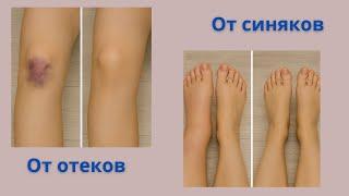 How to quickly remove a bruise at home in a simple way!