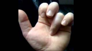 video of my fingers and palm twitching because of nerve damage