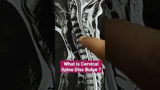 What is Cervical Spine Disc Bulge ? Dr Sai Chandra MBBS DNB Ortho