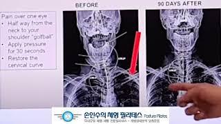 일자목 교정운동 (턱관절 교정, 두통, 어지럼증, 자율신경 이상, 섬유근육통)