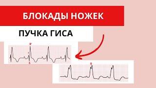 Блокады ножек пучка Гиса. Как различать на ЭКГ?