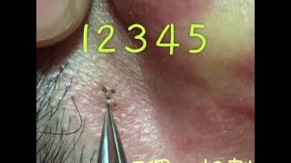 Blackhead Acne Removal