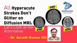 All Hyperacute Strokes Don't Glitter on diffusion MRI, Lets Look for an alternative,#SWI in Stroke#