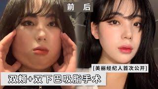 【面部吸脂87cc!】夏依小姐姐24小时换头史（上）双下巴吸脂v脸吸脂