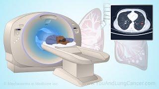 Screening for Lung Cancer