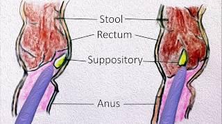 Rectal Suppositories - How to use them?