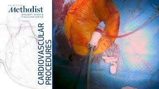 Thoracic Endovascular Repair of Contained Rupture Descending Thoracic Aorta (Bavare, MD, Zubair, MD)