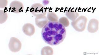 Folate (Folic Acid) & Vitamin B12 Deficiency: Macrocytic Anemia with Target Cells