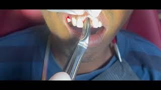 Tooth extraction of central incisor #dentist