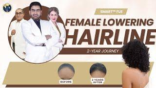 2-Year Journey with SMART™ FUE | GLOJAS AESTHETIC CLINIC