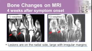 Rheumatoid Arthritis: New Guidelines for Diagnosis and Management