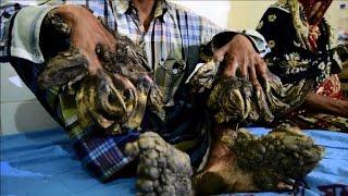 Bangladesh's 'Tree Man' has surgery to remove warts