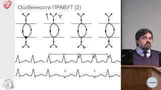 Дифференциальная диагностика регулярных тахикардий