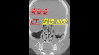 축농증(부비동염) CT 촬영 No! CT는 엑스레이 방사선 50~100배 노출. 미국 알러지 천식 면역학회 자료