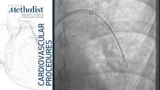 Endovascular Retrieval of Guidewire Fragment from Pulmonary Artery (Bavare MD; White MD; Zubair MD)