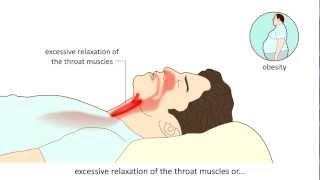 Obstructive Sleep Apnea Syndrome  (OSAS) - Causes and treatment