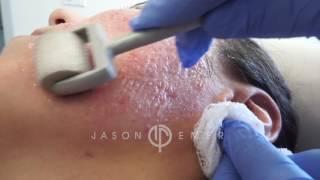 Dermaroller / Microneedling Acne Scars / Skin Resurfacing / Los Angeles, California
