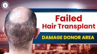 Hair Transplant in Kochi | Cost of Hair Transplant in Kochi | Hair Transplant Doctor in Kochi