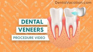 Dental Veneers Procedure Abroad | DentaVacation