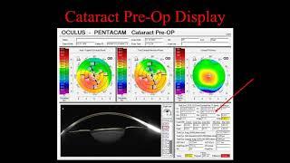 [Online Seminar] Michael Belin: Clinical Pearls for Utilizing the OCULUS Pentacam®