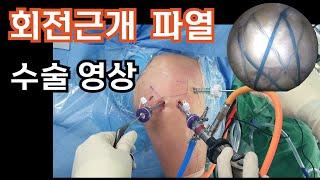 Shoulder surgery : arthroscopic rotator cuff repair