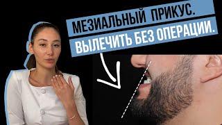 Мезиальный прикус. Как исправить без операции?