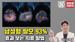 남성형 탈모 하루 1알로 쉽게 치료하자 (안드로겐형탈모, 프로페시아, 아보다트, Finasteride, 보톡스)