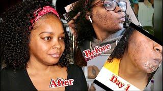 CHEMICAL PEEL FOR HYPERPIGMENTATION/MELASMA | BEFORE & AFTER