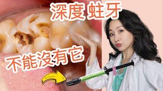 『補牙必看』出現這個狀況 要馬上跟牙醫說！補牙完 牙齒變敏感？@DrTeresa