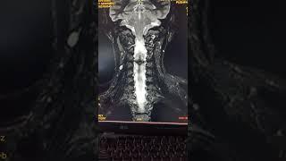 MRI cervical spine planning for sag plane diagnosticradiology #diagnosticimaging #mriscan #mritech