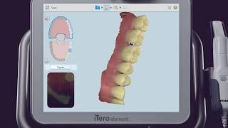 iTero® Scanner Tutorial: Scanning and Charting for a Single Unit Prep