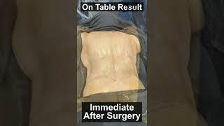 Back Role and Back Fat Removed by Liposuction | Before and After Result