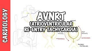 AVRNT (atrioventricular re-entry tachycardia) - causes, pathophysiology, treatment