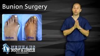 What To Expect After Bunion Surgery