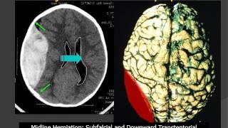MedPix® Traumatic Brain Injury - Epidural Hematoma: Radiologic-Pathologic Correlation