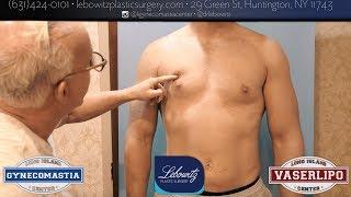 Ultra Hi-Def Liposculpture, Post Gynecomastia Surgery, Long Island VaserLipo Center, NY, Dr Lebowtiz