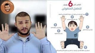 كل ما يجب معرفته عن متلازمة داون من الألف إلي الياء( Down Syndrome)