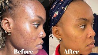 SIMPLE SKINCARE ROUTINE FOR OILY, ACNE PRONE SKIN | HOW I TRANSFORMED MY SKIN | ELOHOR KOLEOWO