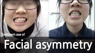 Treatment case of Facial asymmetry 안면비대칭 치료사례