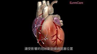 【1分鐘理解心臟搭橋手術】《 Understand  Coronary Artery Bypass Grafting (CABG)  in 1 min 》