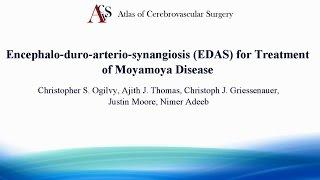 Encephalo duro arterio synangiosis EDAS for Treatment of Moyamoya Disease