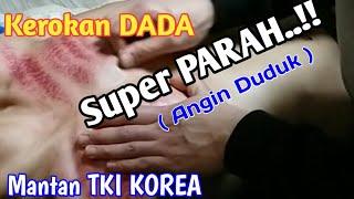 Kerokan DADA ( Masuk Angin ) Super Parah..!!  Mantan TKI KOREA