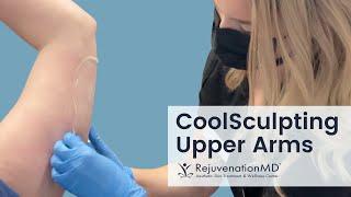 CoolSculpting Upper Arm Fat