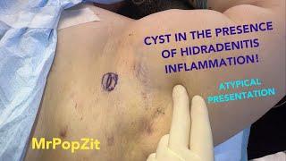 Not your normal cyst!See how different a cyst can look in the presence of scar tissue! It tricks me