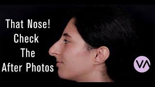 Rhinoplasty - Amazing Before After Photos from Vanity #rhinoplasty #nosejob