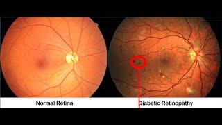 Detecting & Implementing Diabetic Retinopathy with AI |  +91-7973788405 for query| Webtunix AI