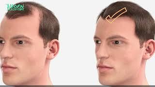 Hairtransplant at Adorn Laser Care