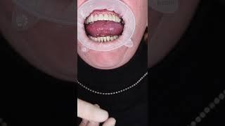Dental implant’s in Prague #shorts #dentist #dental #implant #veneers #short
